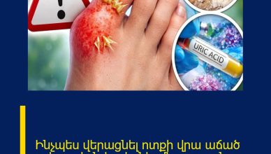 Ինչպես վերացնել ոտքի վրա աճած ոսկորը և նվազեցնել միզաթթուն