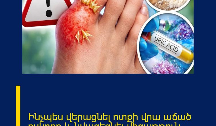 Ինչպես վերացնել ոտքի վրա աճած ոսկորը և նվազեցնել միզաթթուն